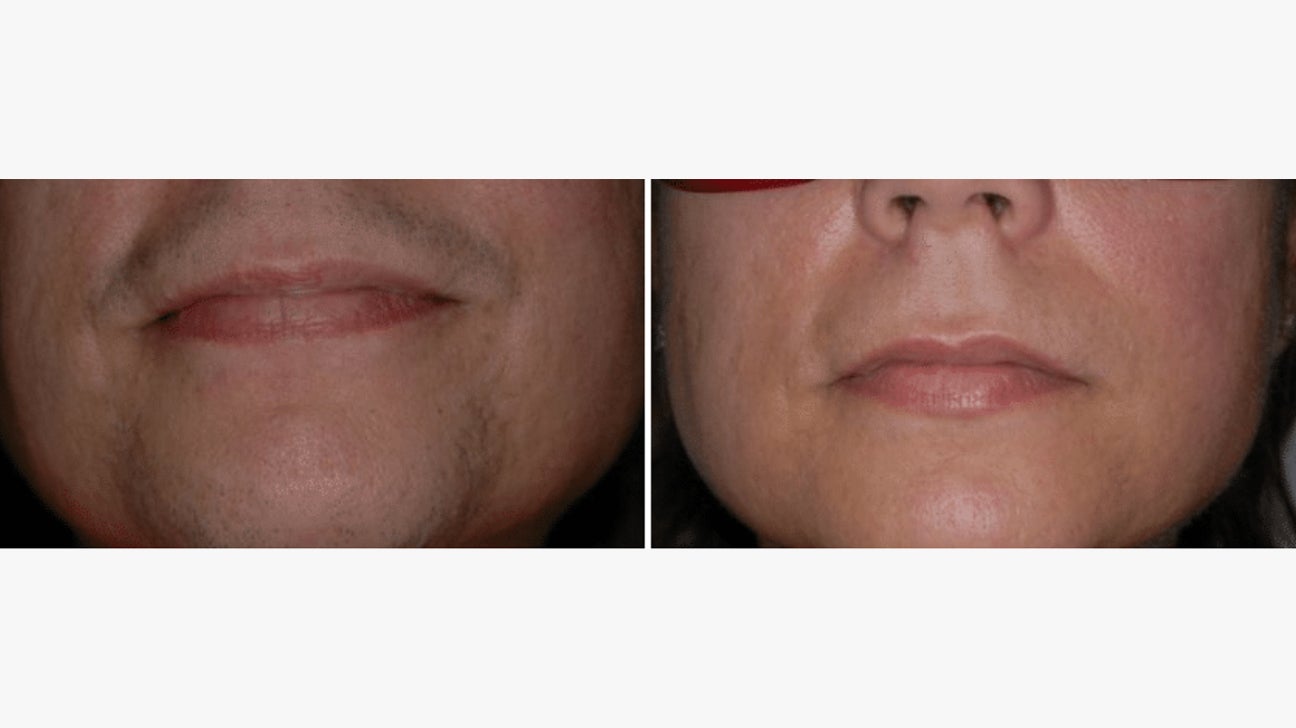 Facial laser hair removal