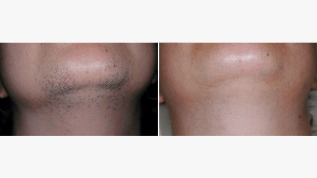 Laser treatment for on sale facial hair