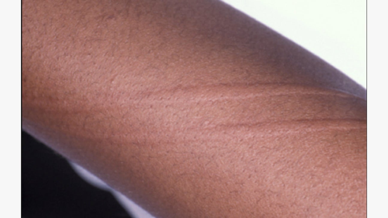 heat rash on african american skin