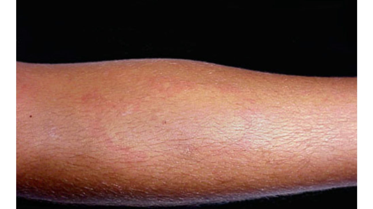 Hives On Black Skin Appearance Symptoms And Pictures