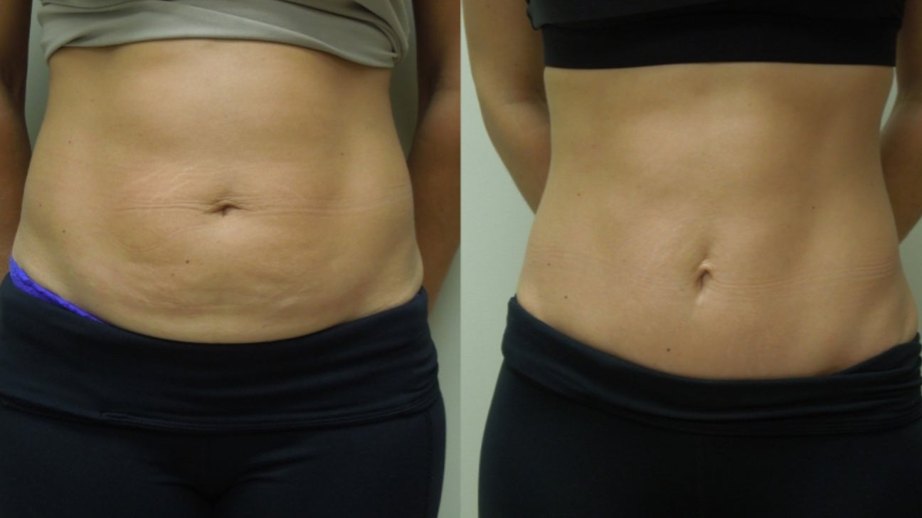 What's the difference between mini tummy tuck (mini-abdominoplasty) & tummy  tuck? Abdominoplasty 