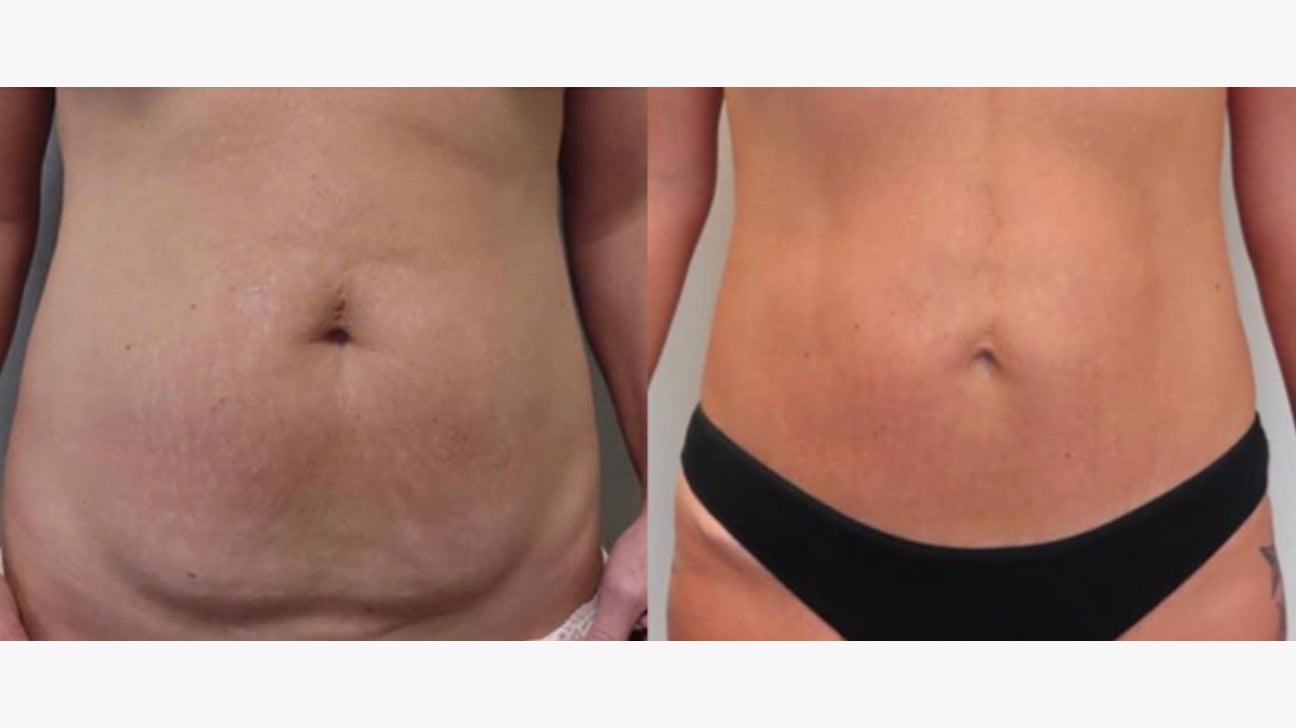 Mini Tummy Tuck Before And After 