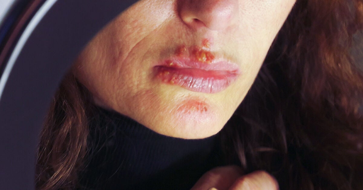 What to use for a cold sore on your lip Recurrent Herpes Simplex Labialis