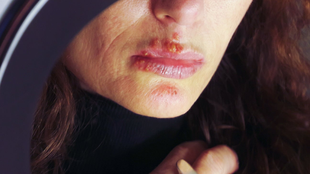 Recurrent Herpes Simplex Labialis   Woman With Herpes On Lips 1296x728 Header 