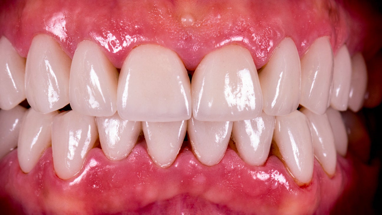 What Are Black Triangles Between Your Teeth?