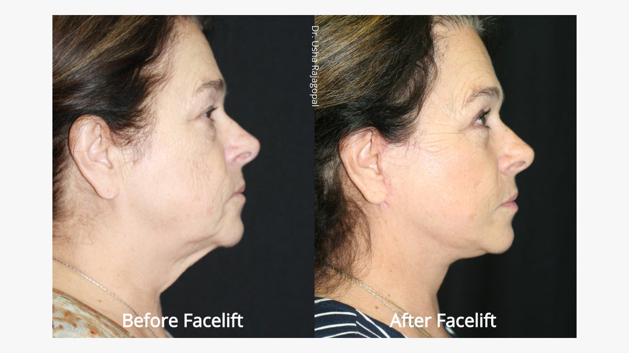 Mid-Facelift: Cost, Procedure, and What to Expect