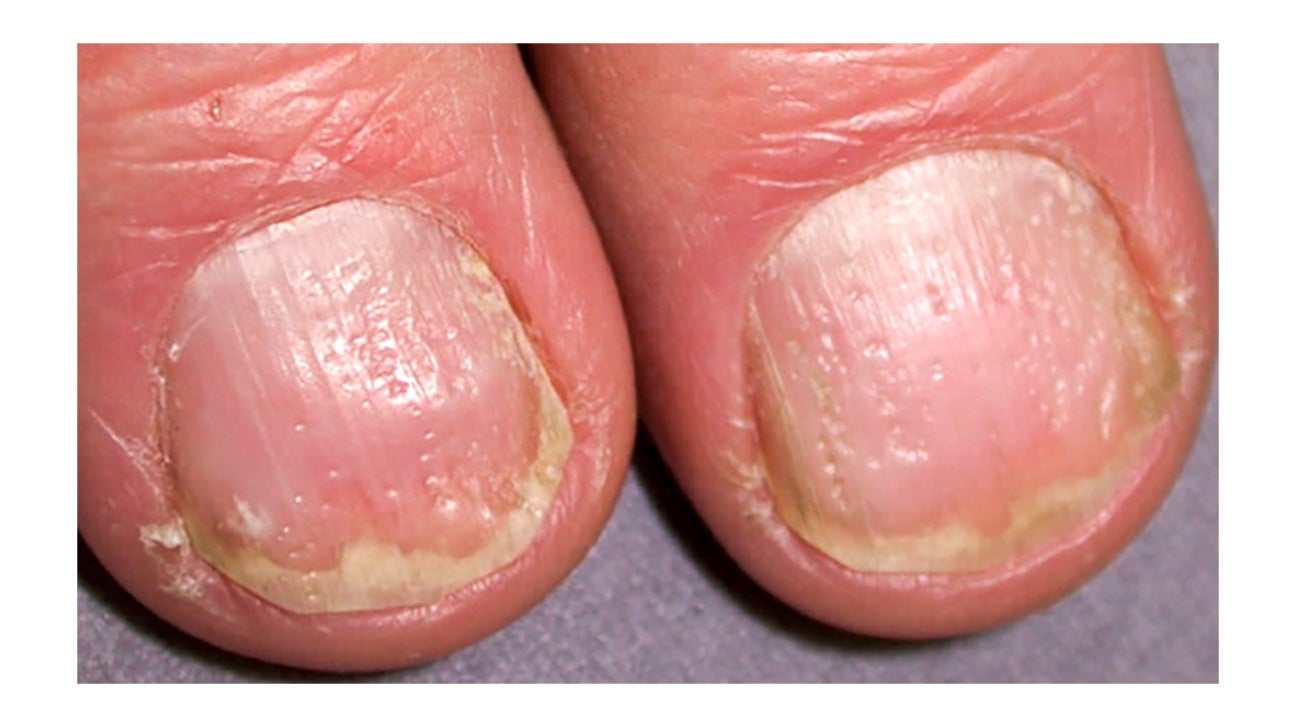 nail ridging psoriasis