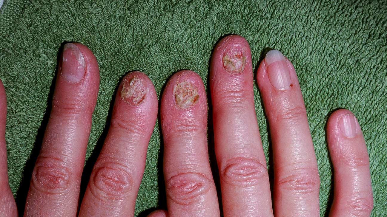 Psoriatic Arthritis Fingernails What Are The First Signs Of Psoriatic Psoriatic Arthritis Fingernails What Are The First Signs Of Psoriatic