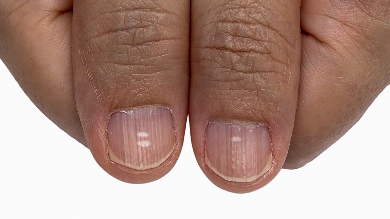 Indents fingernails small on Dents in