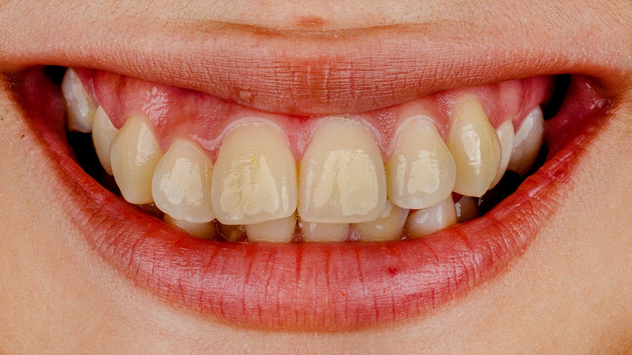 After the braces: Keeping teeth straight « Smiles by White