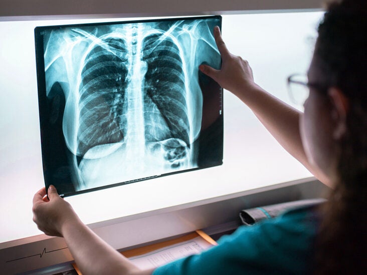 6 Myths About Lung Cancer, Debunked