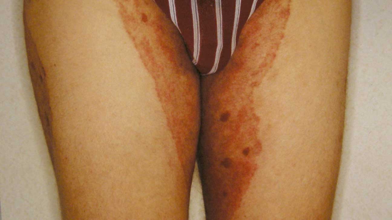 Inverse Psoriasis or Jock Itch: Which Is It?