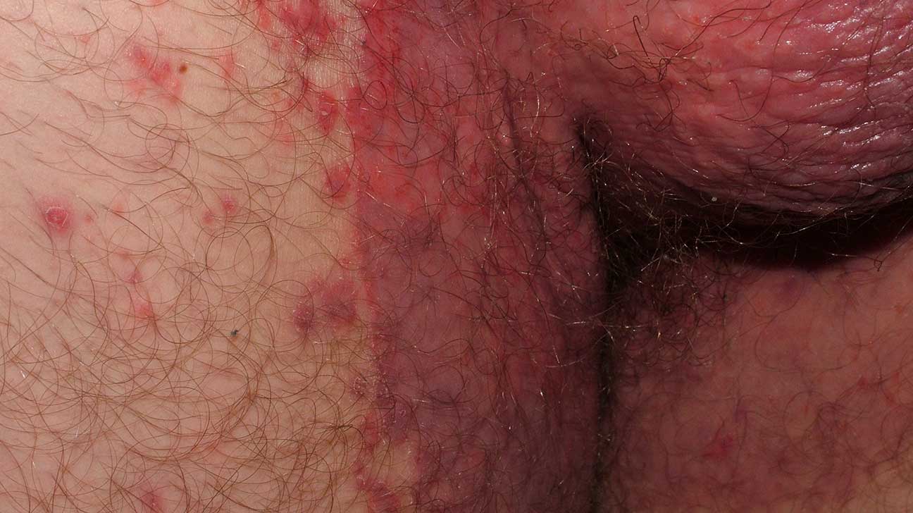 inverse psoriasis smell)