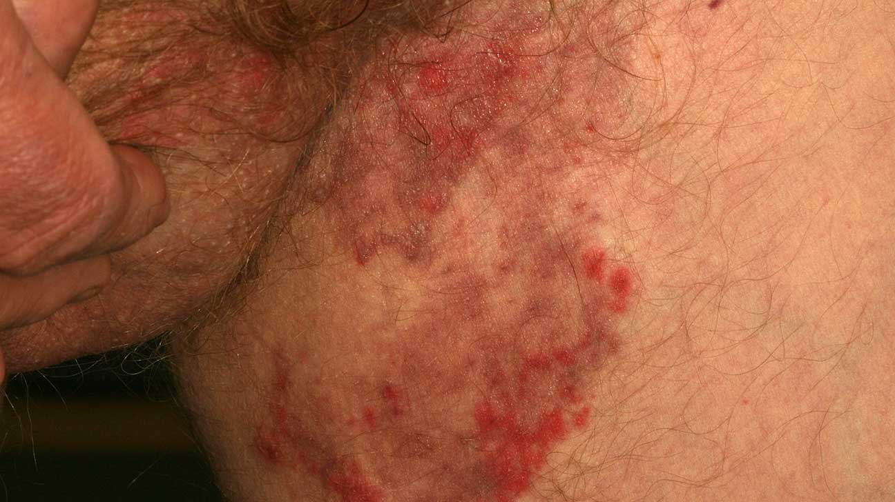 inverse psoriasis or jock itch)