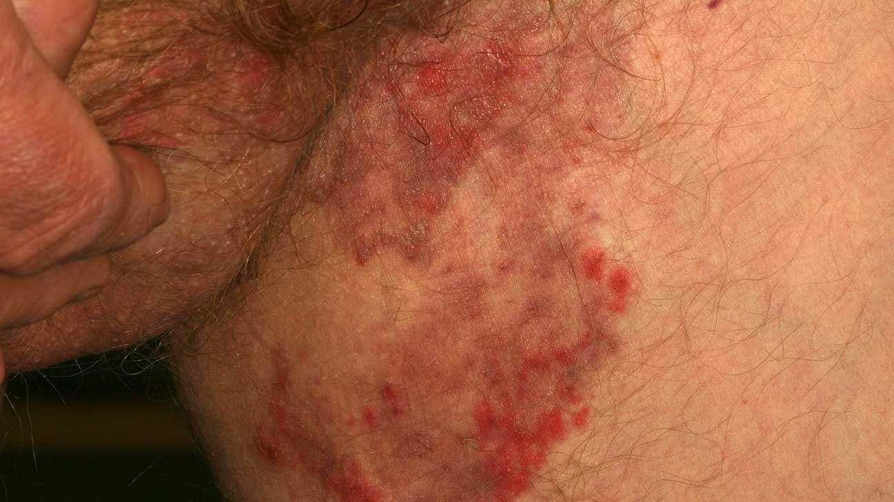 Inverse psoriasis or jock itch? Symptoms, triggers, and treatment