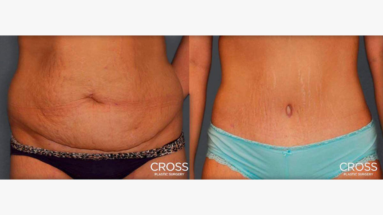 What Happens To The Belly Button After A Tummy Tuck?
