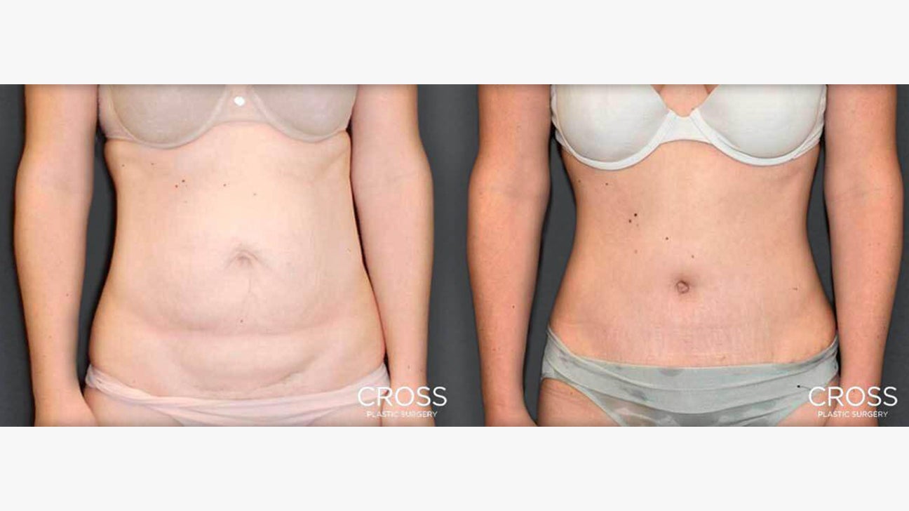 Tummy Tuck: What Happens to the Belly Button? (Before and After