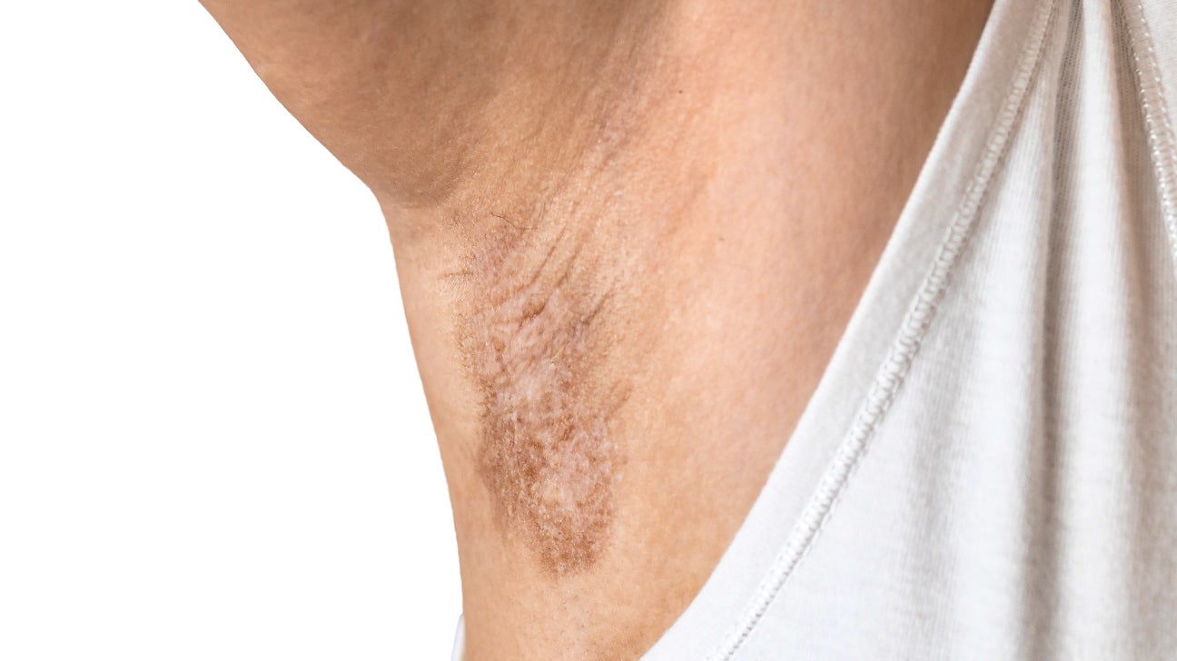 Laser Hair Removal for Men - Thérapie Clinic