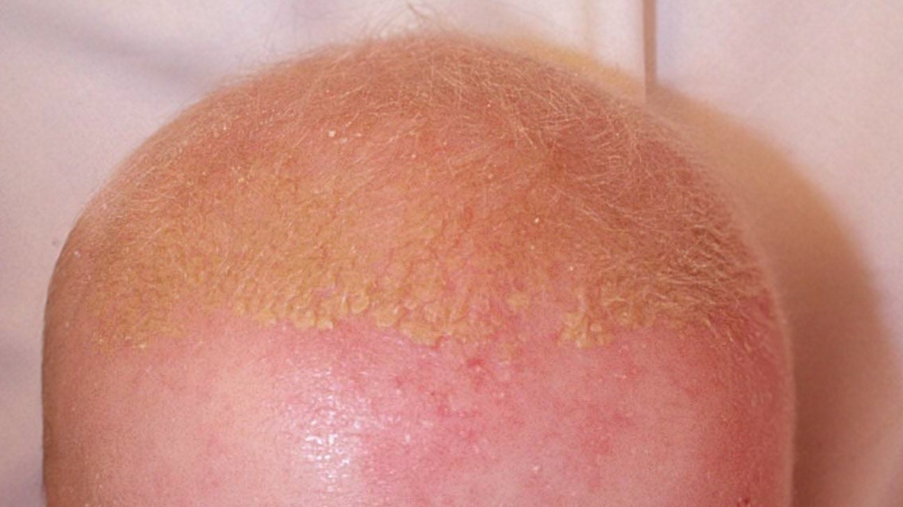 atopic dermatitis on scalp treatment