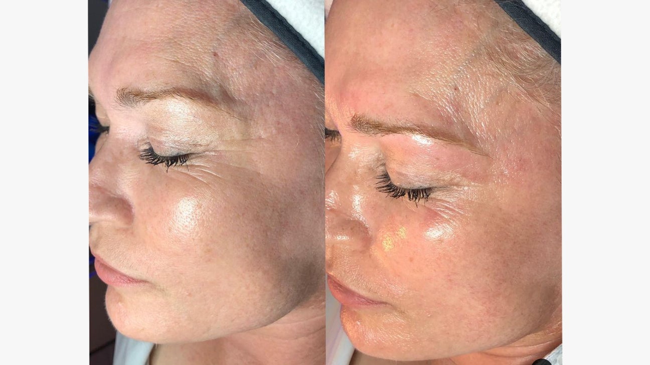 Nashville Chemical Peel