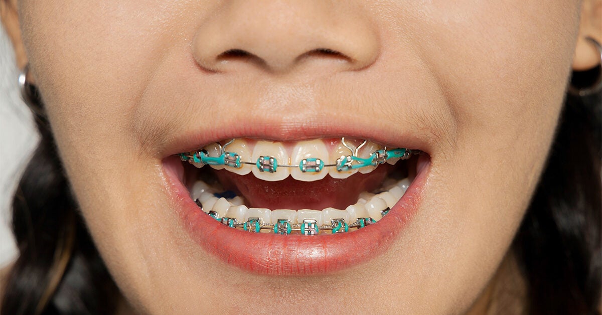 Braces With Rubber Bands Purpose And How Long They Stay On