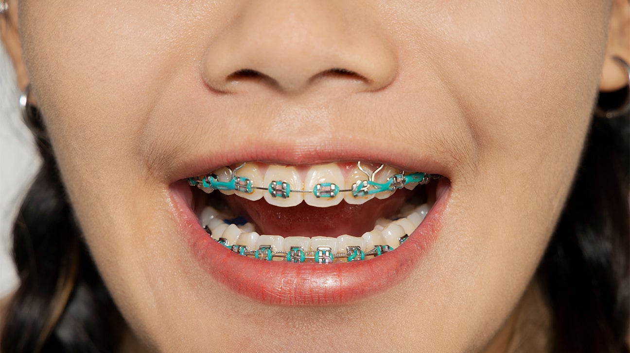 Where can i buy elastics for on sale braces