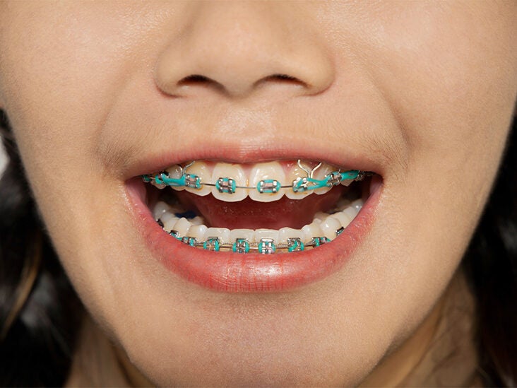 braces color selector