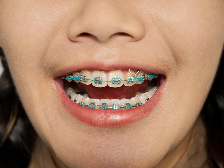 Braces With Rubber Bands Purpose And