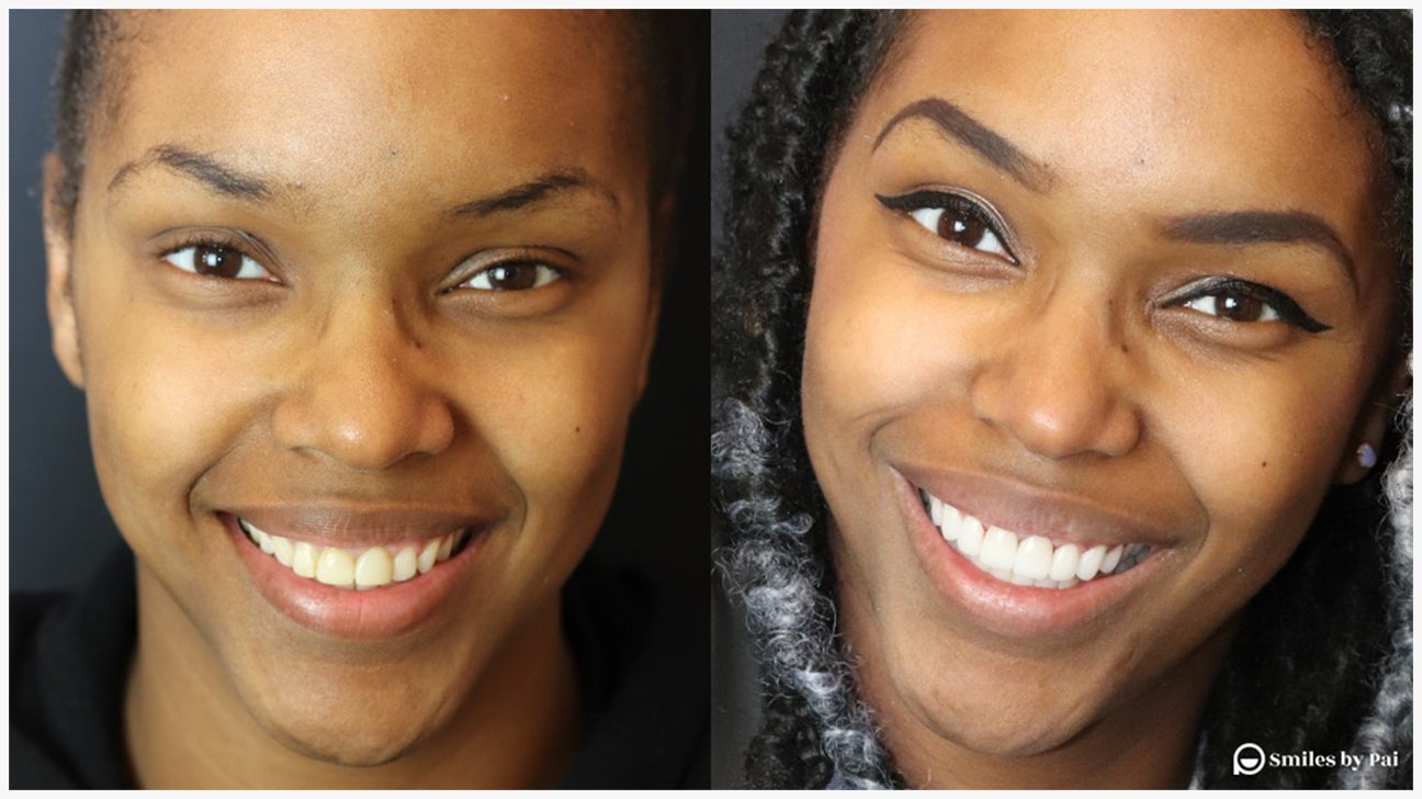 Teeth Veneers Before And After