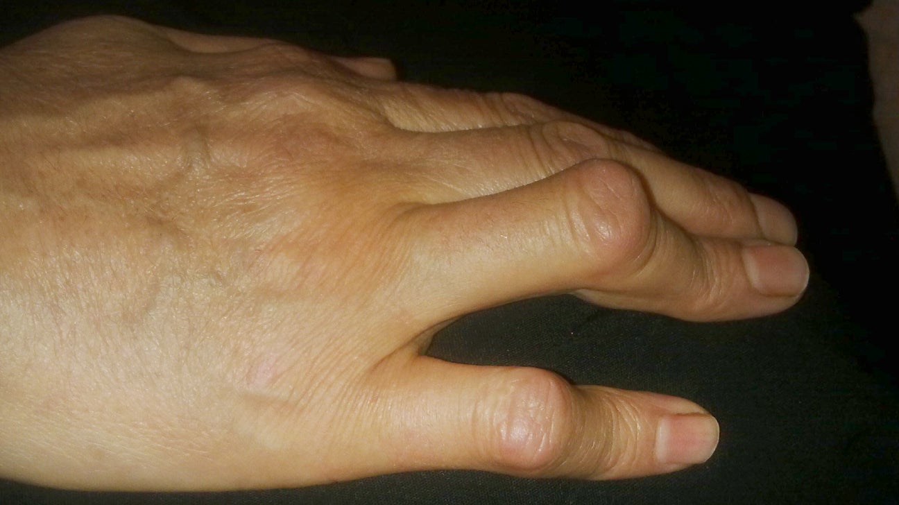 artrita reumatoida deformanta durere dureroasă în fața genunchiului