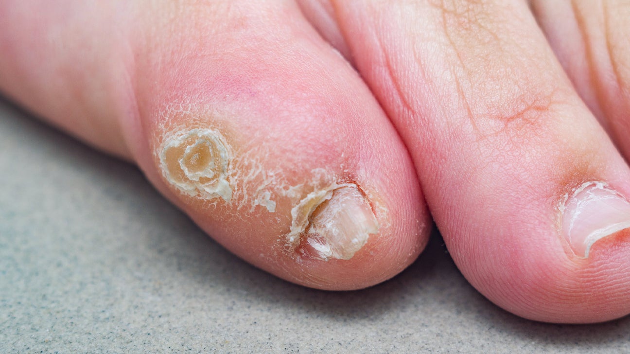 Pinky Toe Corn Causes Treatments and More