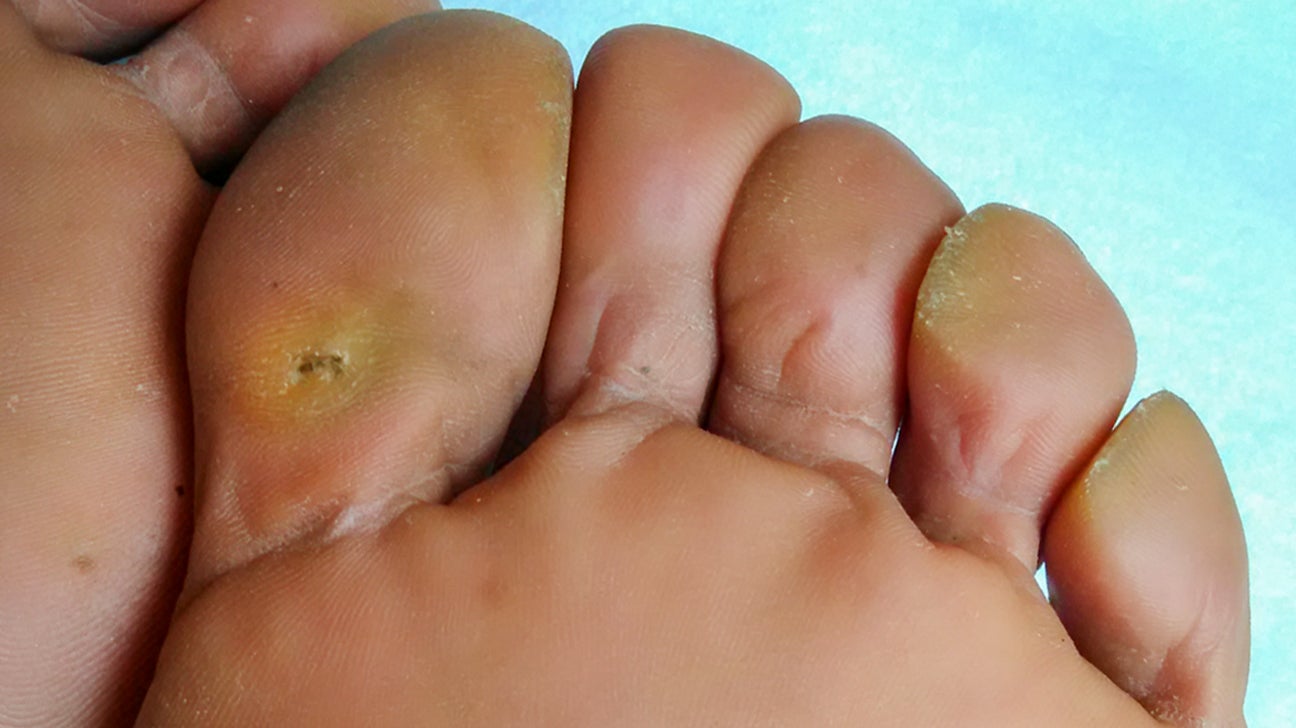 seed wart on foot removal