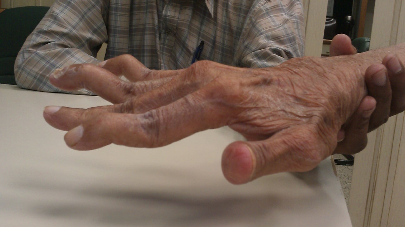 Rheumatoid Arthritis Hand Deformities What To Do