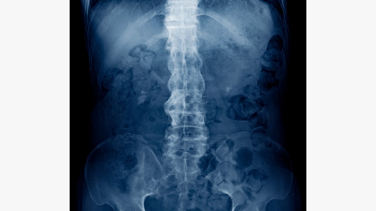 Endoscopic Resection of Symptomatic Cervical Facet Cyst in Ankylosing Spondylitis.