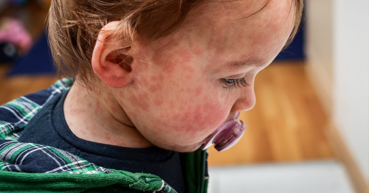 Food allergy rash toddler treatment