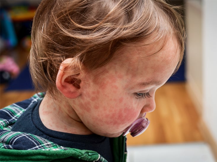 Baby Allergic Reaction To Food Signs And Symptoms