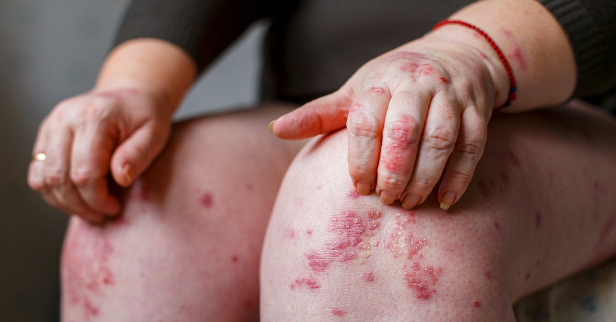 when does psoriasis develop