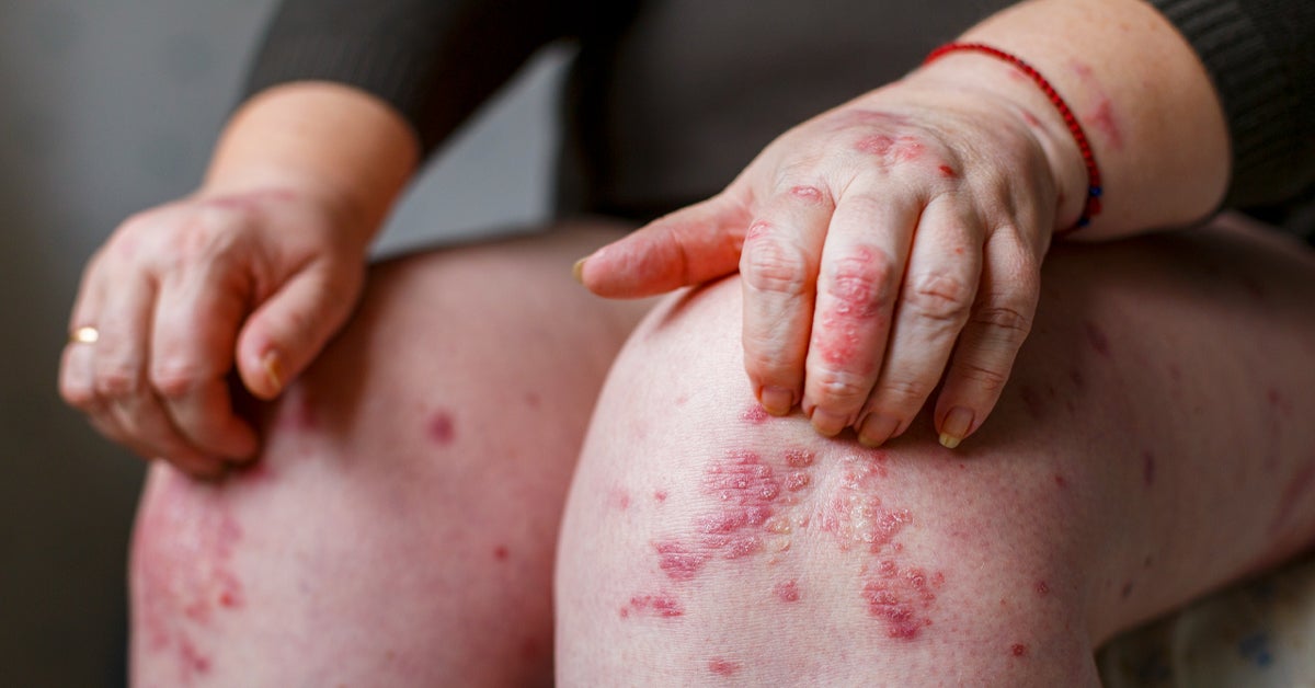 plaque psoriasis and other autoimmune diseases