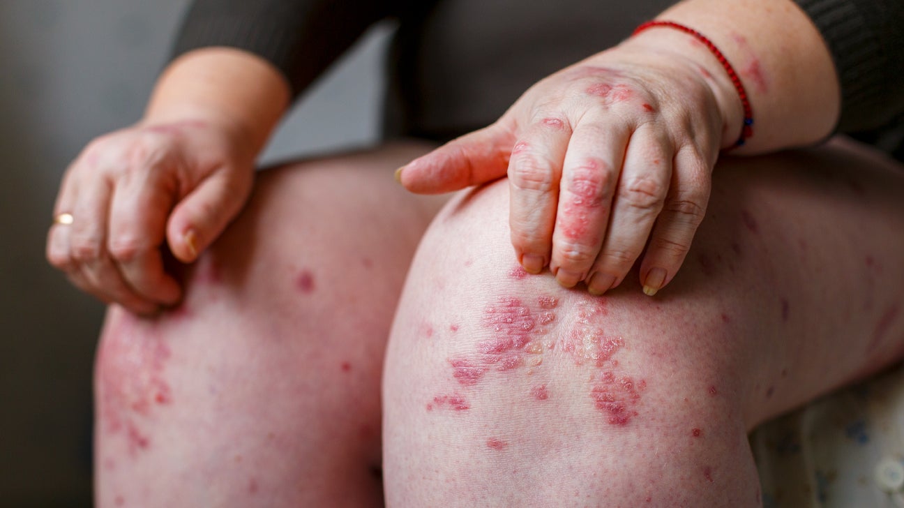 How to Tell Psoriasis Apart From Other Skin Conditions