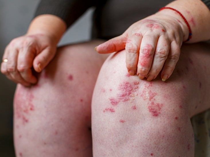 is psoriasis caused by stress)