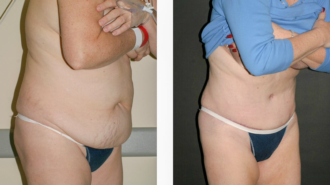 Extended Tummy Tuck: Procedure, Pictures, Cost, and More