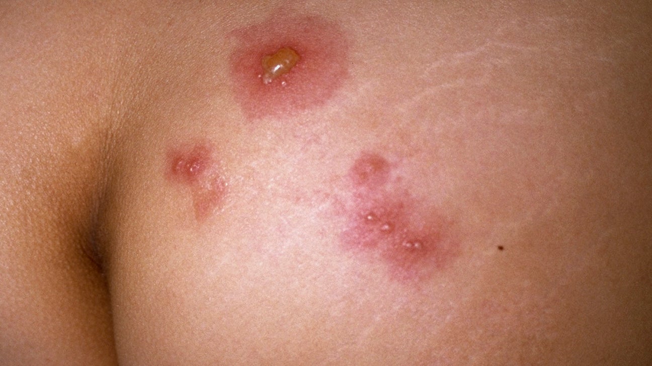 herpes outbreak pictures