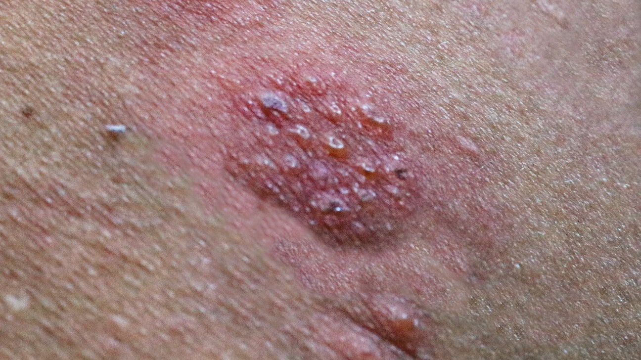 herpes or pimple