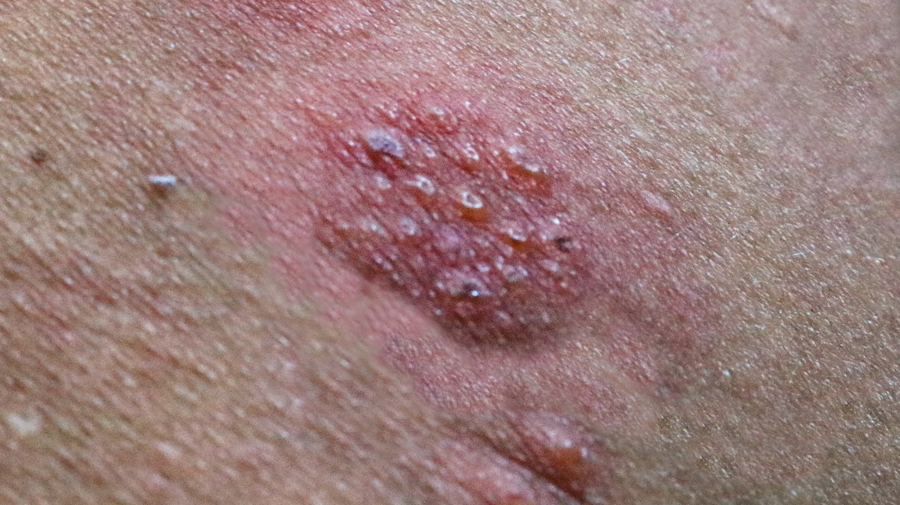 What Does A Herpes Rash Look Like? (With Pictures)