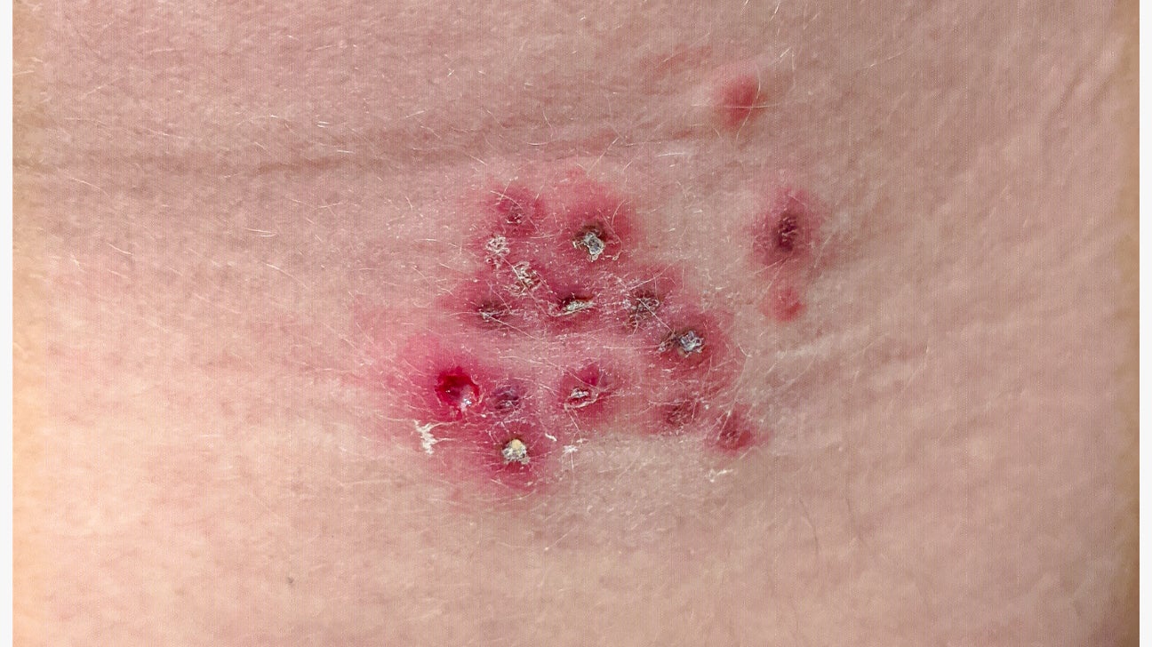 Pictures 2 herpes genital hsv STD Facts