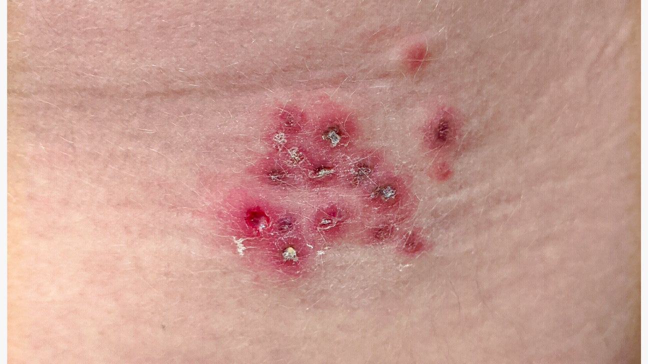 What Does A Herpes Rash Look Like? (With Pictures)