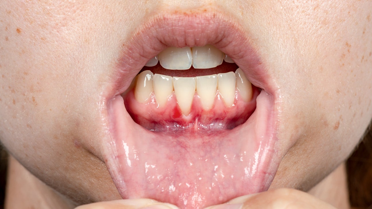 herpetic gingivostomatitis gums