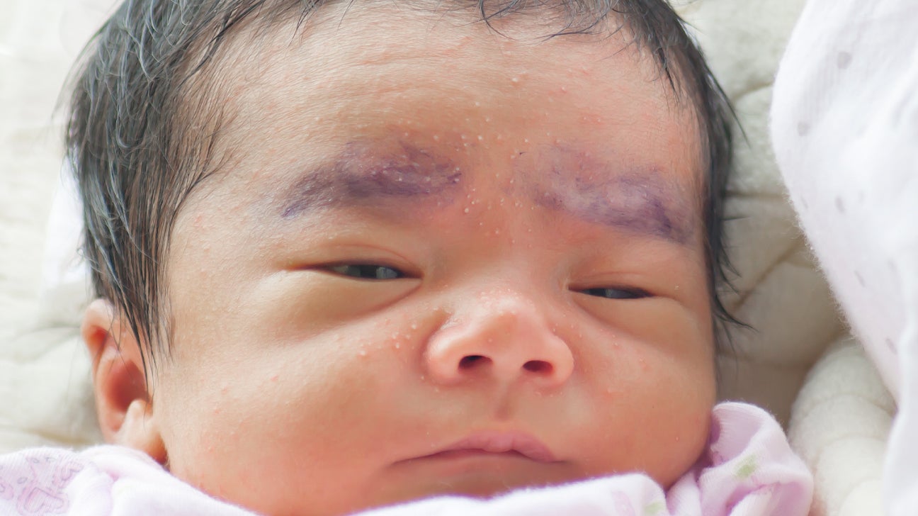 Home Remes For Heat Rash On Baby S Face Tutorial Pics