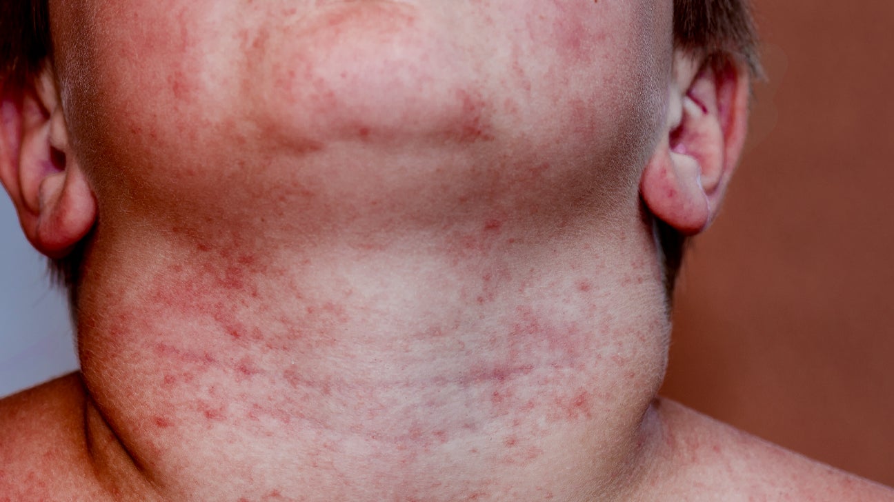 Heat Allergy Rash On Face