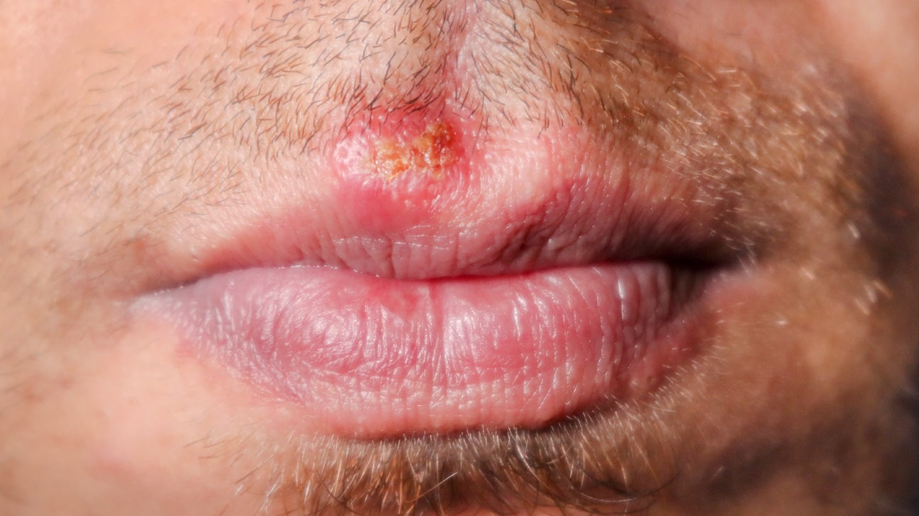 angular cheilitis or cold sore